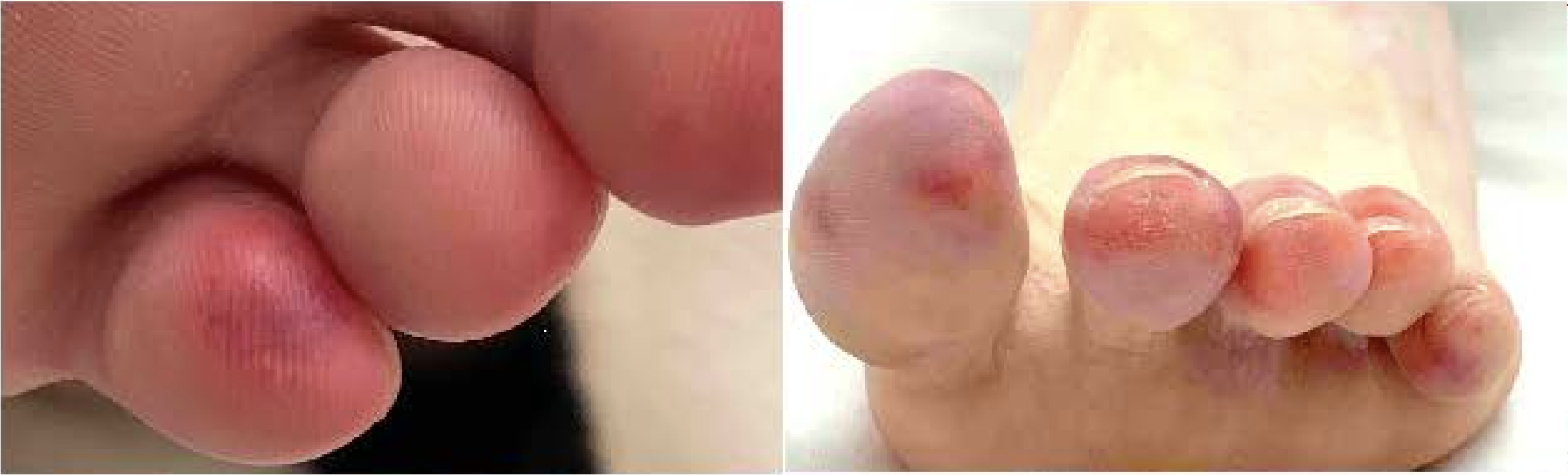 Pernio lesions on the toes